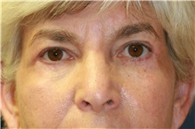 Eyelid Surgery After Photo by Steve Laverson, MD, FACS; Rancho Santa Fe, CA - Case 38894