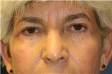 Eyelid Surgery Before Photo by Steve Laverson, MD, FACS; San Diego, CA - Case 38894
