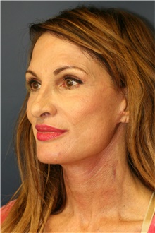 Facelift After Photo by Steve Laverson, MD; San Diego, CA - Case 38895