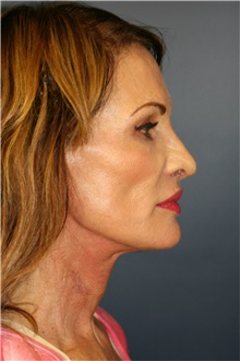 Facelift After Photo by Steve Laverson, MD; San Diego, CA - Case 38895