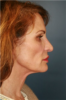 Facelift Before Photo by Steve Laverson, MD; San Diego, CA - Case 38895