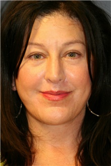 Facelift After Photo by Steve Laverson, MD, FACS; Rancho Santa Fe, CA - Case 38912