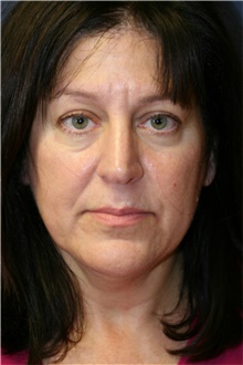 Facelift Before Photo by Steve Laverson, MD, FACS; Rancho Santa Fe, CA - Case 38912