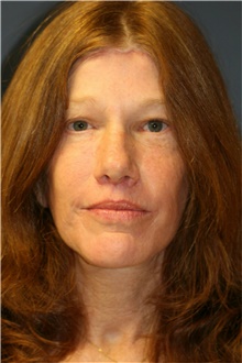 Facelift After Photo by Steve Laverson, MD, FACS; Rancho Santa Fe, CA - Case 38933