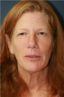 Facelift Before Photo by Steve Laverson, MD, FACS; Rancho Santa Fe, CA - Case 38933