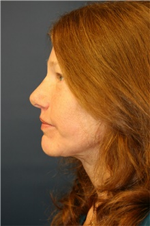 Facelift After Photo by Steve Laverson, MD, FACS; Rancho Santa Fe, CA - Case 38933