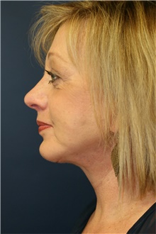 Facelift After Photo by Steve Laverson, MD; San Diego, CA - Case 38935