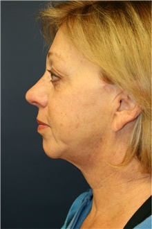 Facelift Before Photo by Steve Laverson, MD; San Diego, CA - Case 38935
