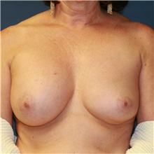 Breast Implant Revision Before Photo by Steve Laverson, MD, FACS; Rancho Santa Fe, CA - Case 38951