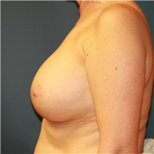 Breast Implant Revision After Photo by Steve Laverson, MD, FACS; Rancho Santa Fe, CA - Case 38951