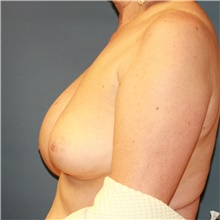 Breast Implant Revision Before Photo by Steve Laverson, MD, FACS; Rancho Santa Fe, CA - Case 38951