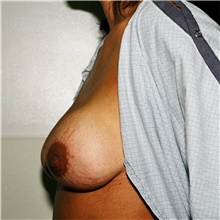 Breast Implant Revision Before Photo by Steve Laverson, MD, FACS; Rancho Santa Fe, CA - Case 38952