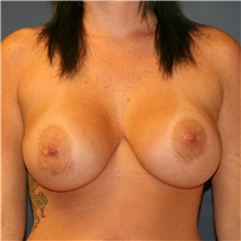 Breast Implant Revision Before Photo by Steve Laverson, MD, FACS; Rancho Santa Fe, CA - Case 38967