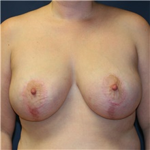 Breast Reduction After Photo by Steve Laverson, MD, FACS; San Diego, CA - Case 38999
