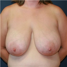 Breast Reduction Before Photo by Steve Laverson, MD, FACS; Rancho Santa Fe, CA - Case 38999