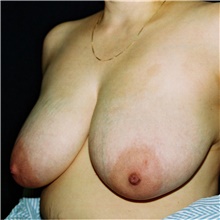 Breast Reduction Before Photo by Steve Laverson, MD, FACS; Rancho Santa Fe, CA - Case 39000