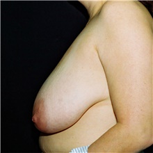Breast Reduction Before Photo by Steve Laverson, MD, FACS; Rancho Santa Fe, CA - Case 39000