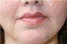 Lip Augmentation/Enhancement After Photo by Steve Laverson, MD, FACS; Rancho Santa Fe, CA - Case 39004