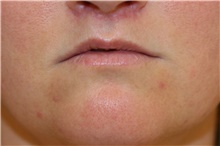 Lip Augmentation/Enhancement After Photo by Steve Laverson, MD, FACS; Rancho Santa Fe, CA - Case 39005