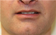 Lip Augmentation/Enhancement After Photo by Steve Laverson, MD, FACS; Rancho Santa Fe, CA - Case 39035
