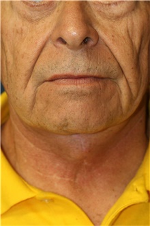 Neck Lift After Photo by Steve Laverson, MD, FACS; Rancho Santa Fe, CA - Case 39036