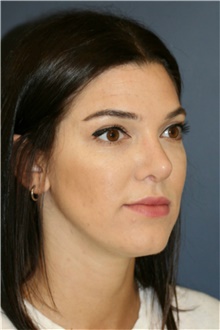 Rhinoplasty After Photo by Steve Laverson, MD, FACS; Rancho Santa Fe, CA - Case 39060