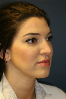 Rhinoplasty Before Photo by Steve Laverson, MD, FACS; Rancho Santa Fe, CA - Case 39060