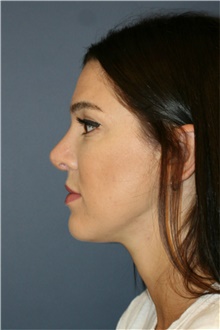 Rhinoplasty After Photo by Steve Laverson, MD, FACS; Rancho Santa Fe, CA - Case 39060