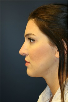 Rhinoplasty Before Photo by Steve Laverson, MD, FACS; Rancho Santa Fe, CA - Case 39060