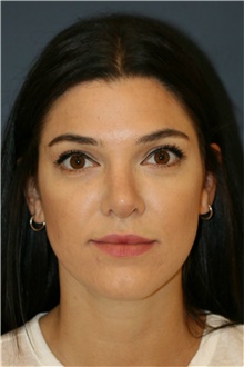 Rhinoplasty After Photo by Steve Laverson, MD, FACS; Rancho Santa Fe, CA - Case 39060