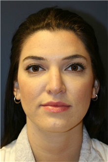 Rhinoplasty Before Photo by Steve Laverson, MD, FACS; Rancho Santa Fe, CA - Case 39060