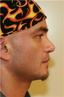 Rhinoplasty After Photo by Steve Laverson, MD, FACS; Rancho Santa Fe, CA - Case 39061