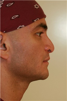 Rhinoplasty Before Photo by Steve Laverson, MD, FACS; Rancho Santa Fe, CA - Case 39061