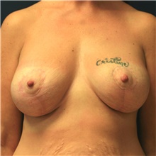 Breast Lift After Photo by Steve Laverson, MD, FACS; Rancho Santa Fe, CA - Case 39077