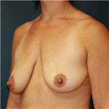 Breast Lift Before Photo by Steve Laverson, MD; San Diego, CA - Case 39078