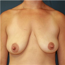 Breast Lift Before Photo by Steve Laverson, MD, FACS; San Diego, CA - Case 39078