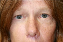 Eyelid Surgery After Photo by Steve Laverson, MD, FACS; Rancho Santa Fe, CA - Case 39093