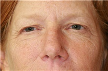 Eyelid Surgery Before Photo by Steve Laverson, MD, FACS; San Diego, CA - Case 39093