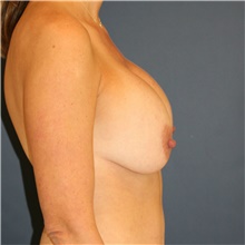 Breast Lift Before Photo by Steve Laverson, MD; San Diego, CA - Case 39105
