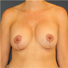 Breast Lift After Photo by Steve Laverson, MD; San Diego, CA - Case 39105