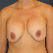 Breast Lift Before Photo by Steve Laverson, MD; San Diego, CA - Case 39105