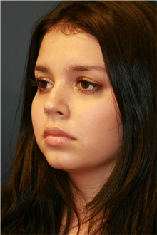 Rhinoplasty After Photo by Steve Laverson, MD, FACS; Rancho Santa Fe, CA - Case 39107