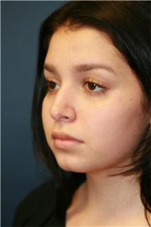 Rhinoplasty Before Photo by Steve Laverson, MD, FACS; Rancho Santa Fe, CA - Case 39107