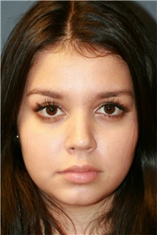 Rhinoplasty After Photo by Steve Laverson, MD, FACS; Rancho Santa Fe, CA - Case 39107