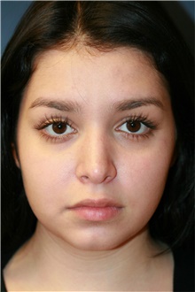 Rhinoplasty Before Photo by Steve Laverson, MD, FACS; Rancho Santa Fe, CA - Case 39107