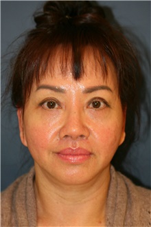 Facelift After Photo by Steve Laverson, MD; San Diego, CA - Case 39165