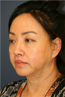 Facelift Before Photo by Steve Laverson, MD; San Diego, CA - Case 39165