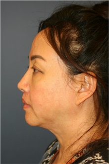 Facelift Before Photo by Steve Laverson, MD; San Diego, CA - Case 39165