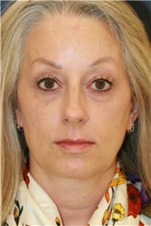 Facelift Before Photo by Steve Laverson, MD, FACS; San Diego, CA - Case 39166