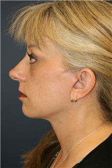 Facelift After Photo by Steve Laverson, MD, FACS; San Diego, CA - Case 39166